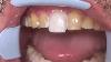 Houston Cosmetic Dentist Step By Step Procedure For Porcelain Veneers Conservative Preps
